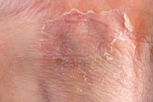 Eczema_the_Itch_You_Can’t_Scratch