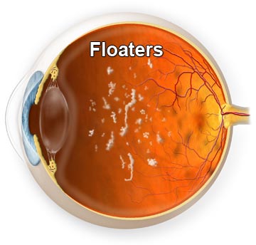Ever Have Floaters in the Eye?