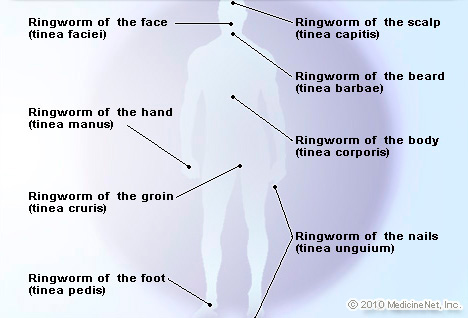 Steroid cream to treat ringworm