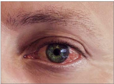 How Long is Pink Eye Contagious?