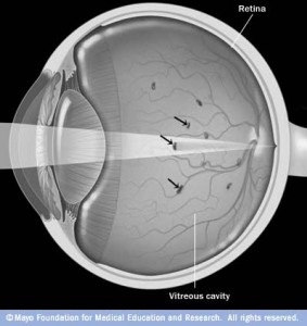 Are_There_Floaters_in_Eye_Sight