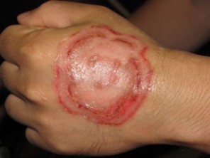 Are There Home Remedies for Ringworm That Work Ringworm on hand
