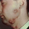 Can I Tell if I have Ringworm from Looking at Ringworm Pictures facial ringworm