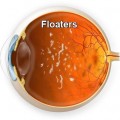 Ever_Have_Floaters_in_the_Eye
