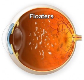 Ever_Have_Floaters_in_the_Eye