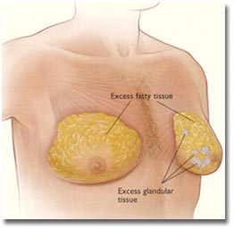 Gynecomastia_Surgery_Cost