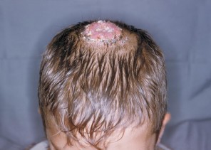 How to Get Rid of Ringworm on the scalp