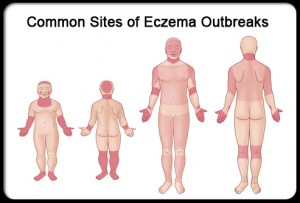 How_to_Treat_Eczema3