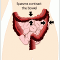 Irritable Bowel Syndrome Treatment is Possible! bowel diagram