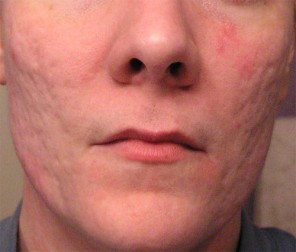 Is Acne Scar Removal Possible rolling scars
