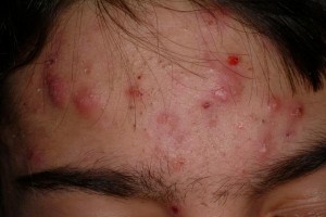 Is Tea Tree Oil Acne Treatment Effective inflammed acne