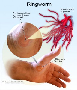 Is There A Real Ringworm Cure illustration