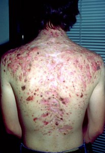 Is There Just One Best Acne Treatment extreme back acne