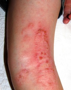Is_There_a_Proven_Eczema_Cure