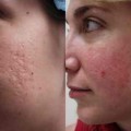 Is There and Acne Scar Treatment That Works dermabration