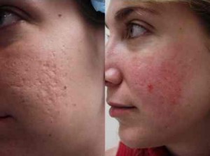 Is There and Acne Scar Treatment That Works dermabration