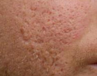 Is There and Acne Scar Treatment That Works acne scars