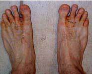 My Feet Are Starting To Look Like Those Athletes Foot Pictures bad athletes foot
