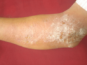 The Symptoms That Eczema Causes Can be Very Irritating eczema on an arm