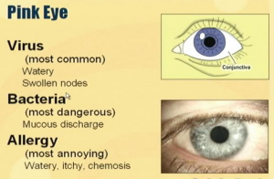 What Are Some of the Home Remedies for Pink Eye chart