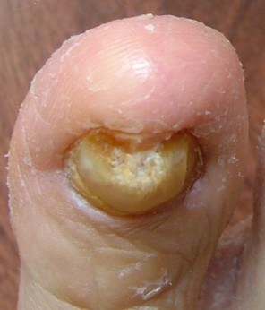 What Can We Learn From Toenail Fungus Pictures infeccted toenail