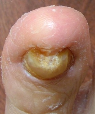 What Can We Learn From Toenail Fungus Pictures infeccted toenail