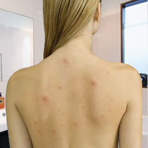 What_Causes_Back_Acne_and_How_Can_You_Get_Rid_of_It woman with back acne
