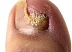 What Exactly is Toe Fungus nail partially gone