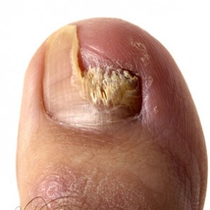 What Exactly is Toe Fungus nail partially gone