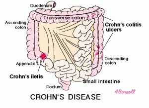 what are chrons disease symptoms illustration