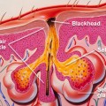 What are Some Common Home Remedies for Acne diagram of blackhead