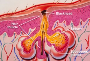 What are Some Common Home Remedies for Acne diagram of blackhead