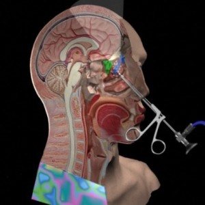 What are the Types of Sinus Surgery sinus graphic