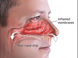 Z:\6 EmbarrassingProducts.com\11 Nasal Congestion\nasal cong images\What_can_I_do_About_this_Runny_Nose illustration