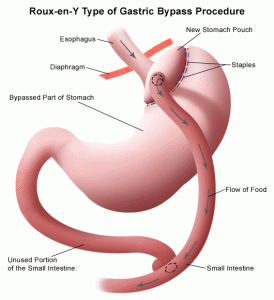 What_is_Gastric_Bypass_Surgery