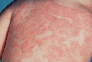 What is This Skin Fungus back rash