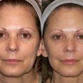 What is a Mini Face Lift before and after
