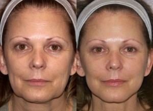 What is a Mini Face Lift before and after