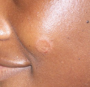 What is the Fastest Ring Worm Treatment facial ringworm
