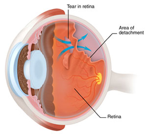 What is the Most Common Eye Floaters Treatment illustration