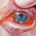 What is the Most Common Eye Floaters Treatment eye trauma