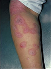 Which Eczema Cream is the Best eczema on arm