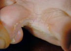Will Antifungal Cream Take Care of Athlete’s Foot infected toes