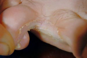 Will Antifungal Cream Take Care of Athlete’s Foot infected toes