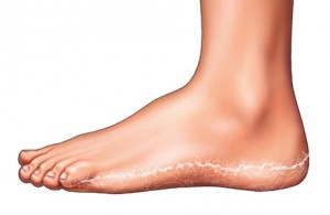 Will Antifungal Cream Take Care of Athlete’s Foot diagram of foot
