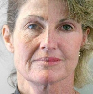 Will a Non Surgical Face Lift Work before and after