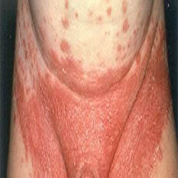 Yeast Infection in Men yest in midriff