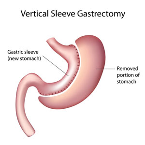 gastric sleeve surgery diagram