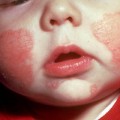 home_remedies_for_Eczema baby with eczema