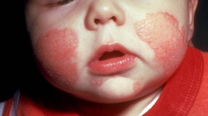 home_remedies_for_Eczema baby with eczema
